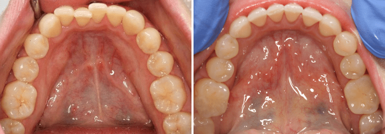 Detalle de la sonrisa de un paciente antes y después del tratamiento Invisalign